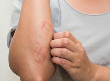 Dermatite de contato - Blog Dra Izabella Rached