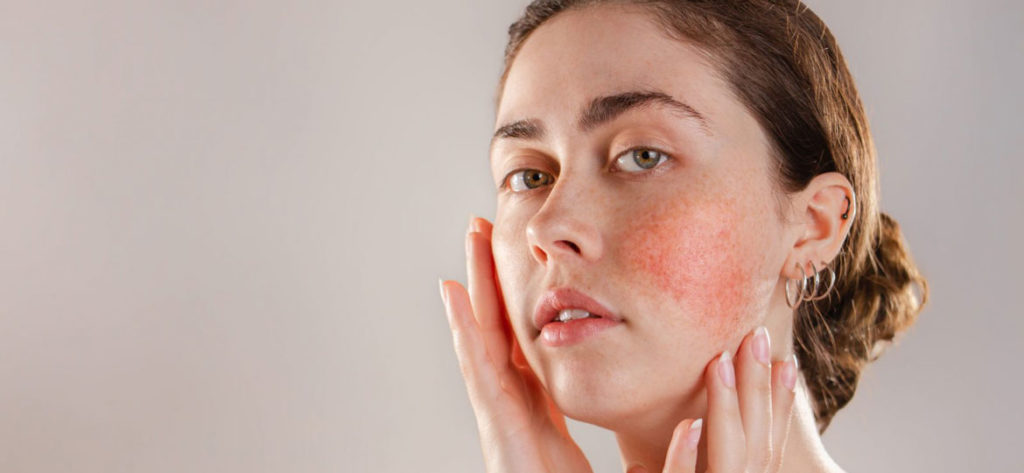 rosacea