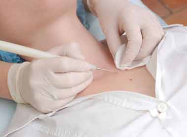 Dermatologia Cirúrgica procedimento de eletrocoagulação