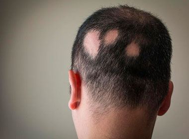 Tratamento para alopecia areata ou pelada