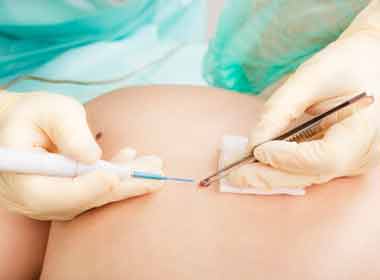 Dermatologia Cirúrgica procedimento de biopsia