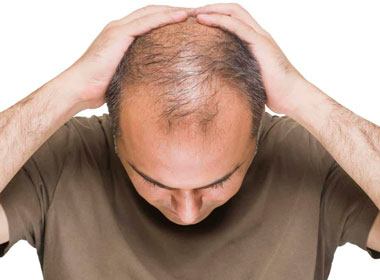 Tratamento para calvice masculina