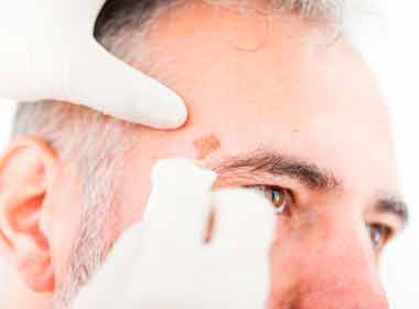 Dermatologia Clínica Tratamento contra Ceratose Actinica