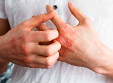 Dermatologia Clínica Tratamento contra Eczema