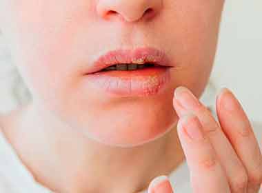 Dermatologia Clínica Tratamento contra Herpes