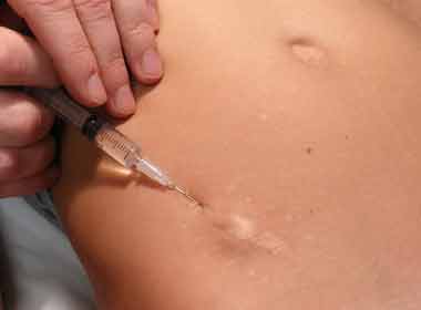 Dermatologia Cirúrgica procedimento de infiltração intralesional