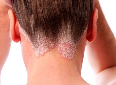 Tratamento para psoriase do couro cabeludo