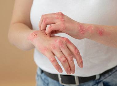 Dermatologia Clínica Tratamento contra Psoriase