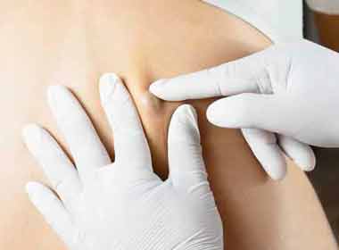 Dermatologia Cirúrgica procedimento de remoção de lipoma
