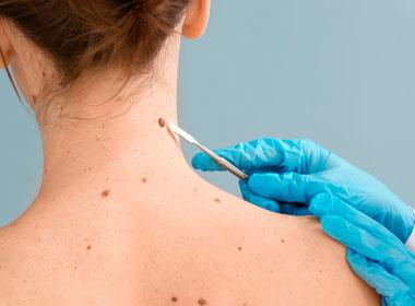 Dermatologia Cirúrgica procedimento de remoção de pintas