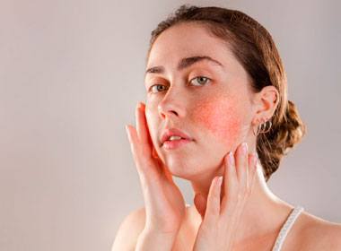 Dermatologia Clínica Tratamento contra rosacea