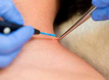 Dermatologia Cirúrgica procedimento de shaving de lesão