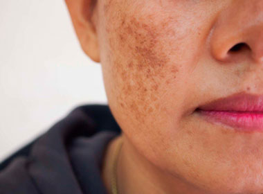 Tratamento para Melasma