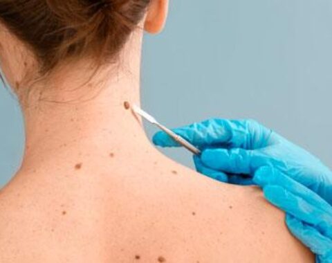 Dermatologia Cirúrgica procedimento de remoção de pintas